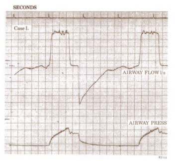 Patient airway pressure and flow traces from the Servo Ventilator.